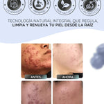 CLEARSTEM | Control Interno Del Acne